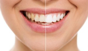 Differenza tra denti gialli e denti bianchi